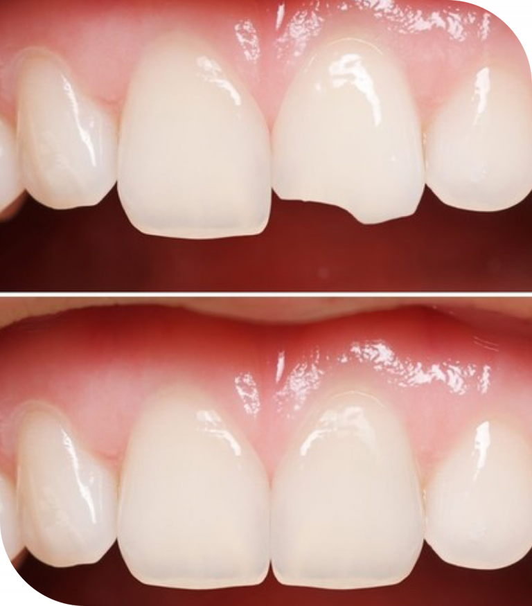 Composite Bonding Antrim House Dental